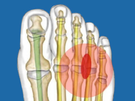 Неврома Мортона