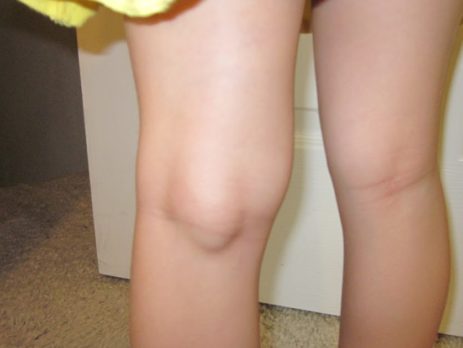 Проявление подколенной кисты у ребенка